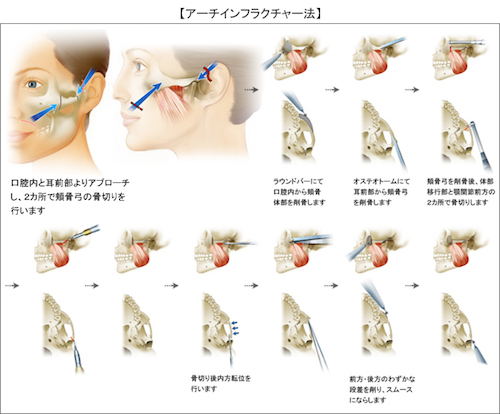 骨切り手術(アーチインフラクチャー法