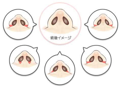鼻翼縮小術内側法・外側法