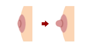 陥没乳頭と違う?　扁平乳頭とは