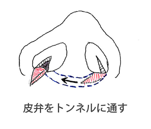 エーラーフラップ法