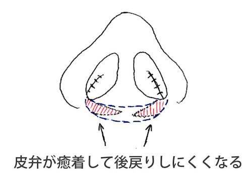 エーラーフラップ法