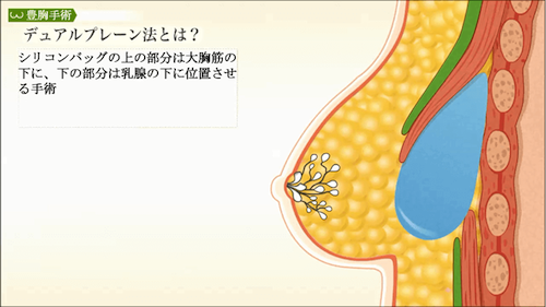 tkcデュアルプレーン法 